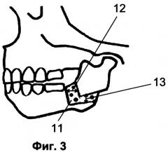 Способ аллопластики при микрогнатии нижней челюсти (патент 2310412)