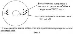 Способ лечения гиперметропии и гиперметропического астигматизма (патент 2313322)