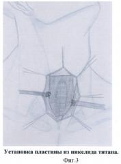 Способ пластики трахеи местными тканями с укреплением передней стенки пластиной из пористого никелида титана и грудино-ключично-сосцевидными мышцами (патент 2449733)