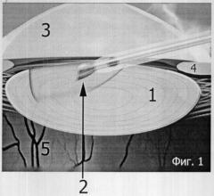 Способ мономануального формирования борозд в ядре хрусталика во время операции ультразвуковой факоэмульсификации методом "вертикального грувинга" (патент 2308249)
