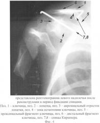 Способ реконструкции надплечья при его деформации (патент 2332182)
