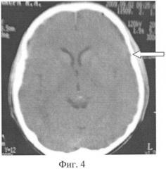 Способ лечения субдуральной гематомы (патент 2414173)