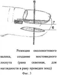 Способ операции при вросшем ногте первого пальца стопы (патент 2460471)