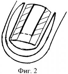 Способ лечения рецидива вросшего ногтя первого пальца стопы (патент 2438597)