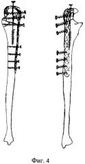 Способ лечения многооскольчатых переломов локтевой кости (патент 2306892)