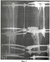 Способ лечения длительносрастающихся, несросшихся переломов и ложных суставов длинных костей (патент 2406462)