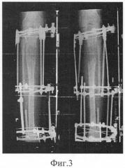 Способ удлинения трубчатой кости (патент 2271766)