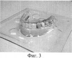 Способ изготовления иммедиат-протеза для лиц с ограниченной мобильностью (патент 2486877)