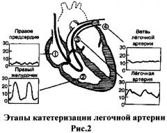 Способ катетеризации легочной артерии (патент 2405584)