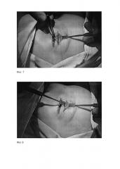 Способ хирургического лечения птоза верхнего века при сохранной или сниженной функции леватора (патент 2605657)