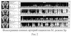 Способ экспресс-диагностики электронным стетоскопом littmann первопричины болевой патологии головы и шеи (патент 2495644)