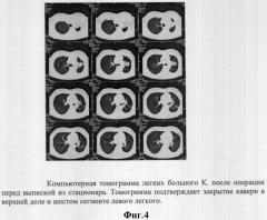 Способ лечения деструктивного туберкулеза легких (патент 2312616)
