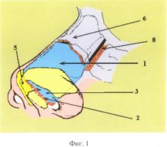Способ репозиции и фиксации хряща носовой перегородки при его вывихе, сочетающемся с наружной травматической деформацией носа (патент 2497470)