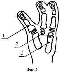 Способ реконструкции пальцев при врожденной патологии кисти (патент 2307612)