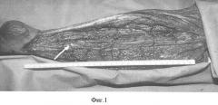 Способ пластики островковым мышечным лоскутом после радикальной хирургической обработки остеомиелитического очага в нижней трети малоберцовой кости (патент 2336838)
