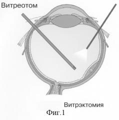 Способ электрохимической деструкции, хирургического удаления и фотодинамической профилактики рецидивов внутриглазных новообразований в среде перфторорганического соединения (варианты) (патент 2244533)