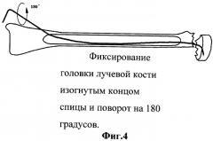 Способ лечения переломов шейки лучевой кости (патент 2342092)