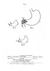 Способ гастродуоденоанастомоза при язвах двенадцатиперстной кишки (патент 1098545)