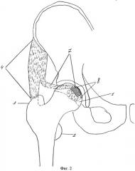 Способ лечения частичной деструкции головки бедренной кости (патент 2471445)