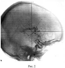 Способ лечения артериовенозных мальформаций головного мозга (патент 2534522)