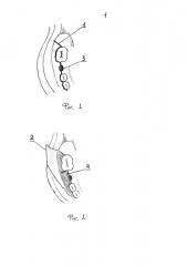 Способ формирования слизисто-надкостничного лоскута при пластике оро-антрального соустья (патент 2599683)