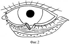 Способ устранения сенильного выворота нижнего века (патент 2380067)