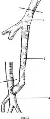 Способ лечения критической ишемии нижних конечностей (патент 2556605)