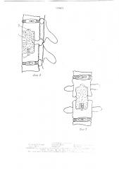 Устройство для переднего спондилодеза (патент 1526675)
