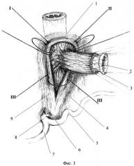Способ толстокишечной гастропластики после гастрэктомии (патент 2278619)