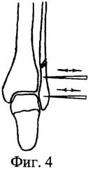 Способ лечения перелома малоберцовой кости в нижней трети диафиза с повреждением межберцового синдесмоза голени (патент 2282411)
