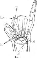 Способ формирования первого пальца кисти (патент 2570770)