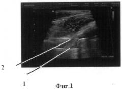 Способ исследования мягких тканей параартикулярной зоны в эндопротезировании тазобедренного сустава (патент 2496423)