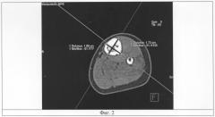 Способ исследования плотности дистракционного регенерата при компьютерной томографии (патент 2289314)