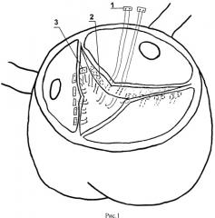 Способ укрепления стенки синусов вальсальвы и имплантации протеза аортального клапана при выполнении операции wheat (патент 2511457)