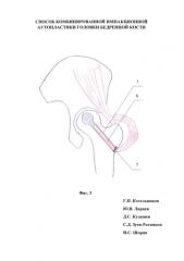 Способ комбинированной импакционной аутопластики головки бедренной кости (патент 2583577)