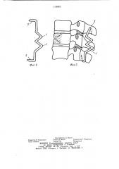 Устройство для фиксации позвоночника (патент 1136803)