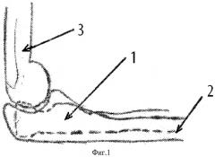 Способ открытого вправления головки лучевой кости при ее вывихе у детей (патент 2421172)