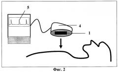 Способ определения места имплантации аппарата для подкожного мониторирования электрокардиограммы (патент 2445917)