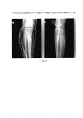 Способ лечения костной опухоли подколенной области (патент 2611889)