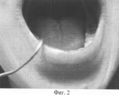 Пассивный электрод для снятия электрических потенциалов тканей зуба аппаратом "дентест" (патент 2325871)