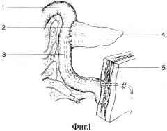 Способ завершения панкреатодуоденальной резекции при неизмененной ткани поджелудочной железы (патент 2272576)
