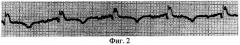Способ электрокардиографической диагностики миокардиодистрофии у новорожденных телят (патент 2292840)