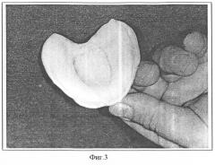 Способ установления оптимальных границ базисов полных съемных протезов верхней и нижней челюстей при неблагоприятных клинических условиях протезного ложа (патент 2274429)