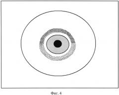 Способ дозированного снижения внутриглазного давления при глаукоме (патент 2572021)