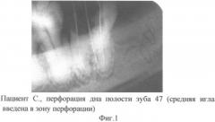 Способ лечения перфорации дна полости зуба (патент 2345732)