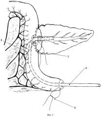 Способ профилактики панкреатита и некроза культи поджелудочной железы после панкреатодуоденальной резекции (патент 2393780)