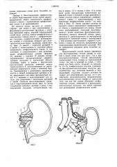 Способ трансплантации почки (его варианты) (патент 1102578)