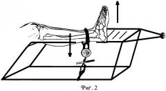 Способ рентгенодиагностики повреждения передней малоберцово-таранной связки голеностопного сустава (патент 2245677)