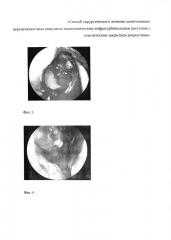Способ хирургического лечения одонтогенных верхнечелюстных синуситов эндоскопическим инфратурбинальным доступом с пластическим закрытием антростомы (патент 2644697)