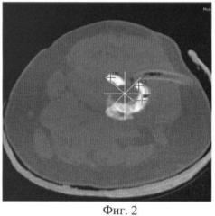 Способ определения границ некротизированных участков длинных трубчатых костей (патент 2452388)